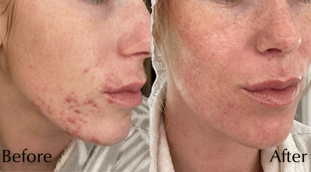 Matcha en acne: Kan het helpen je huid te zuiveren? ✨ - Spoon Moment